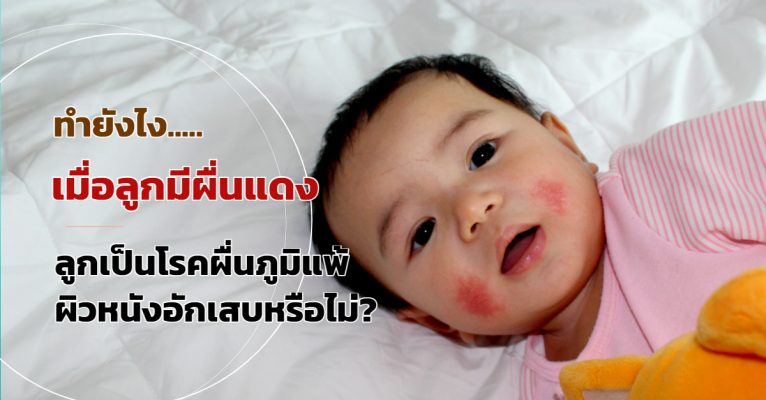 โรคผื่นภูมิแพ้ผิวหนังอักเสบ