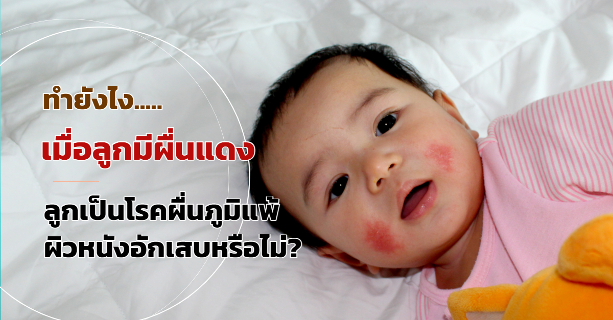 โรคผื่นภูมิแพ้ผิวหนังอักเสบ