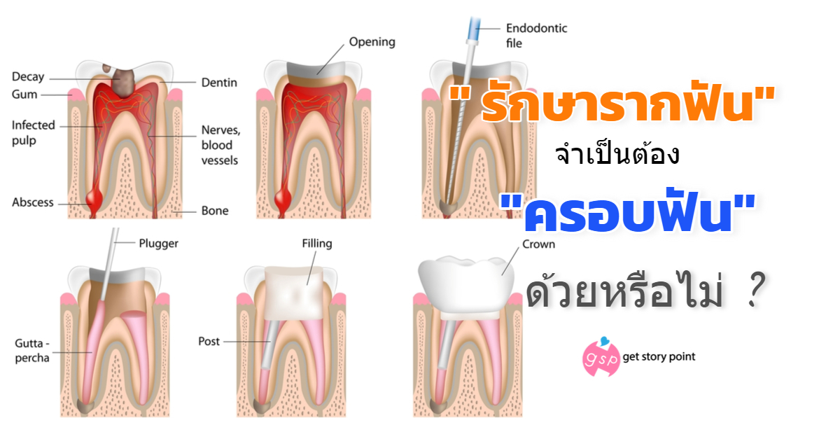 รักษารากฟันจำเป็นต้องครอบฟันหรือไม่