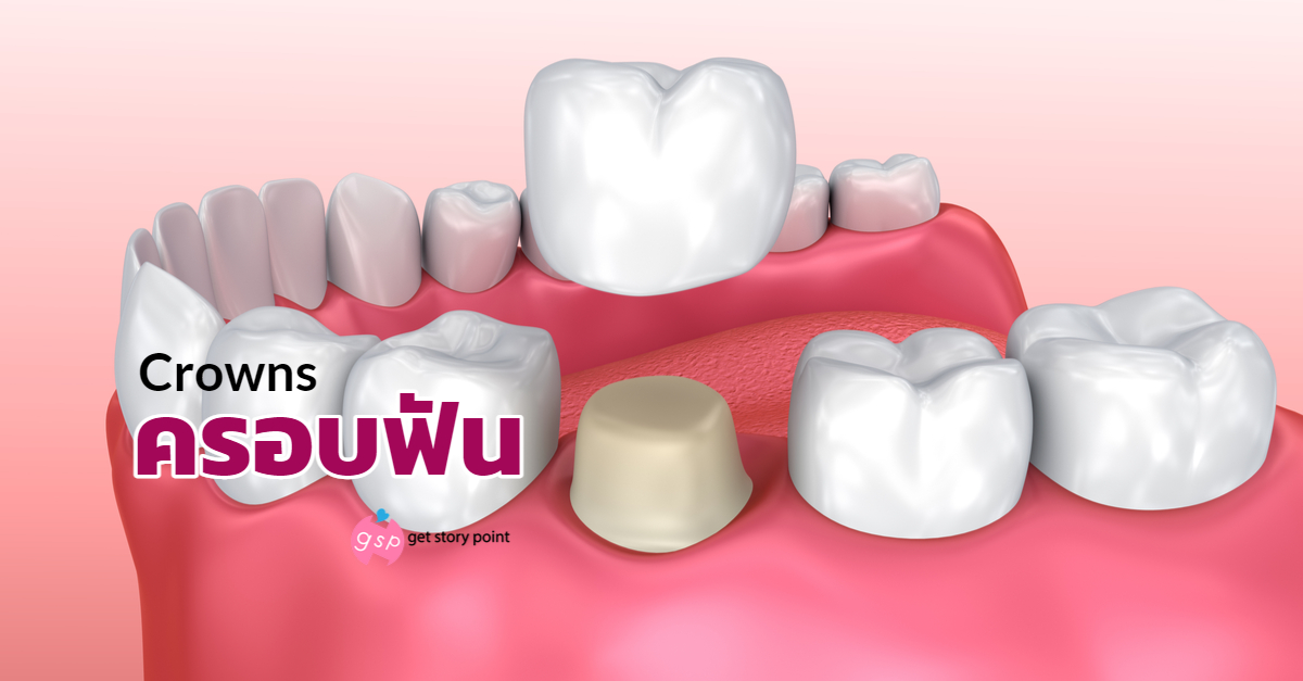 Dental Crowns