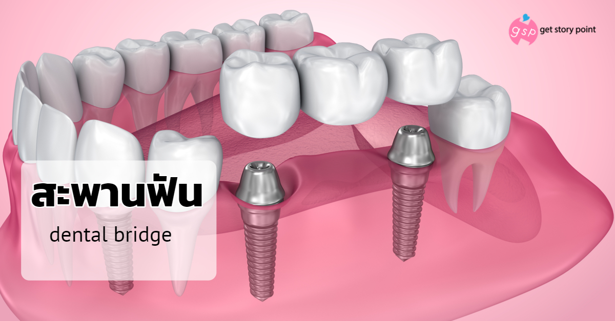 สะพานฟัน (Dental bridge)