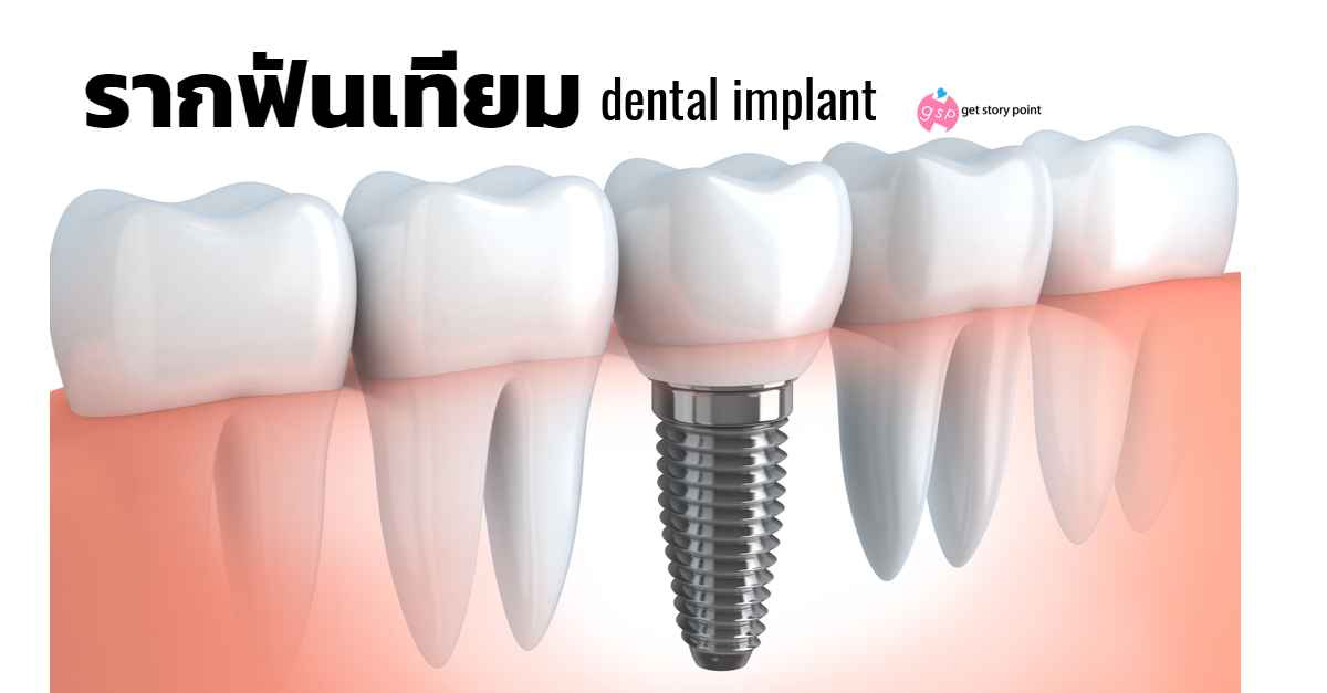 รากฟันเทียม : Dental implant