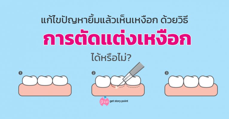 ตัดแต่งเหงือก