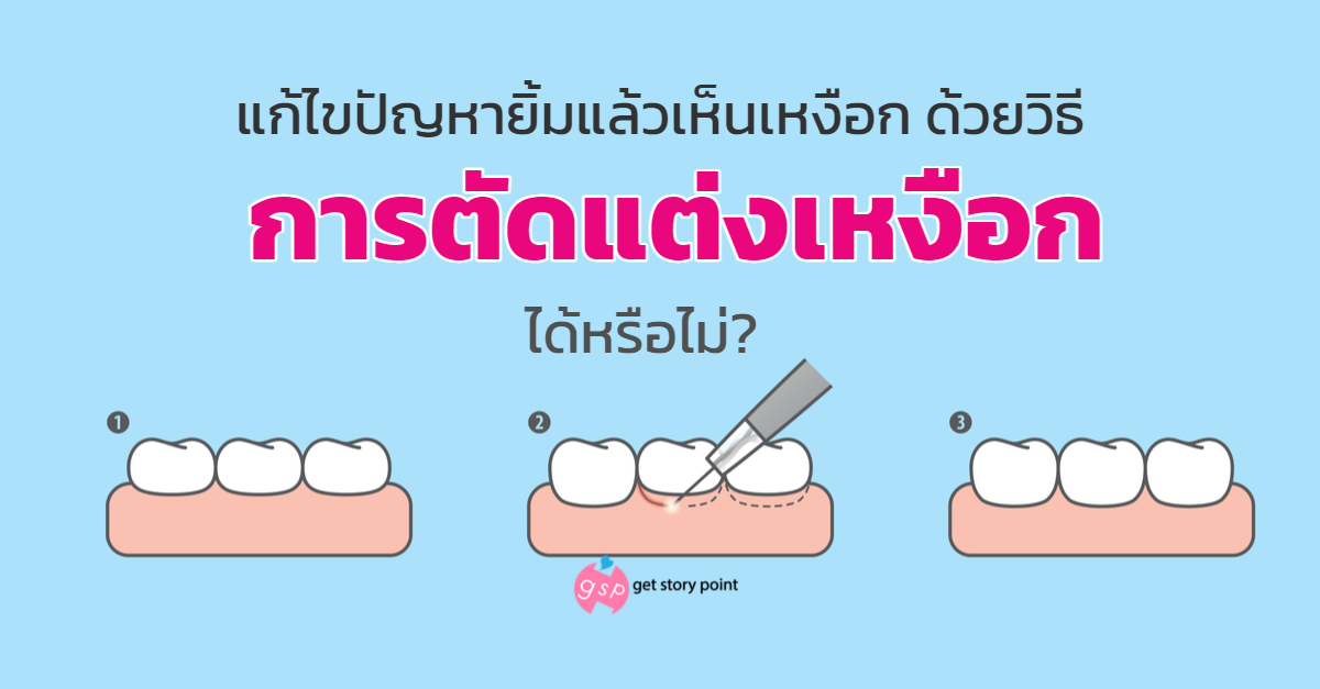 ตัดแต่งเหงือก